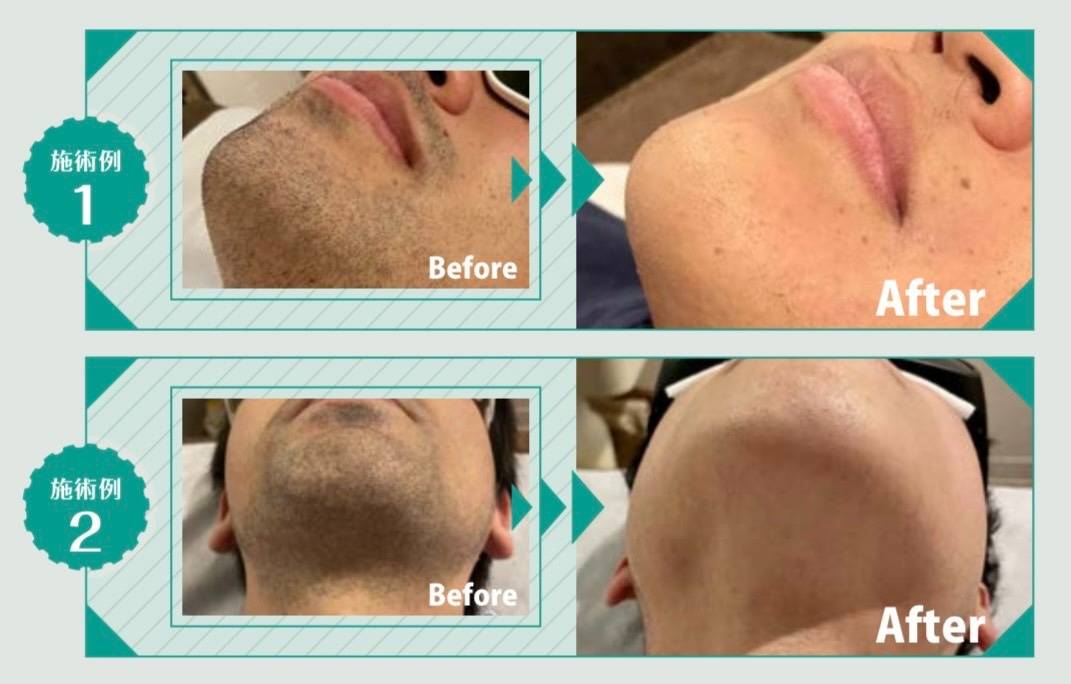 香芝でメンズ脱毛を考えている方へ｜後悔しない選び方