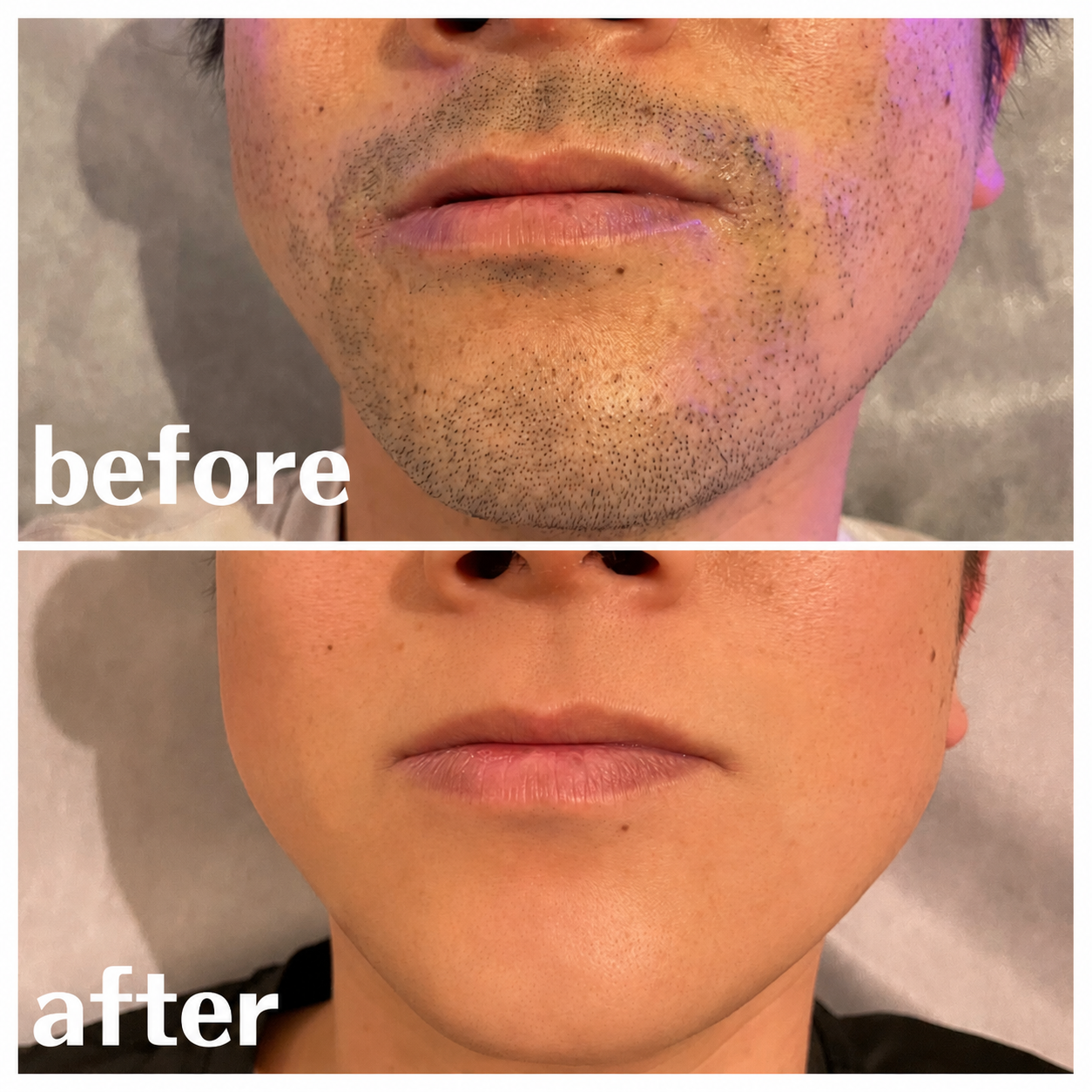 ヒゲ脱毛　BeforeAfter