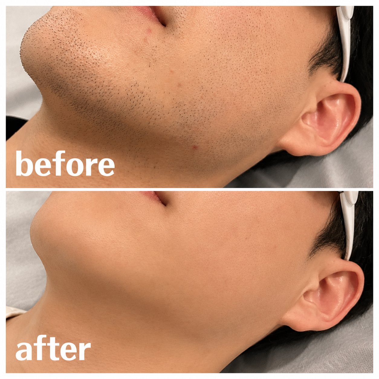 ヒゲ脱毛　BeforeAfter