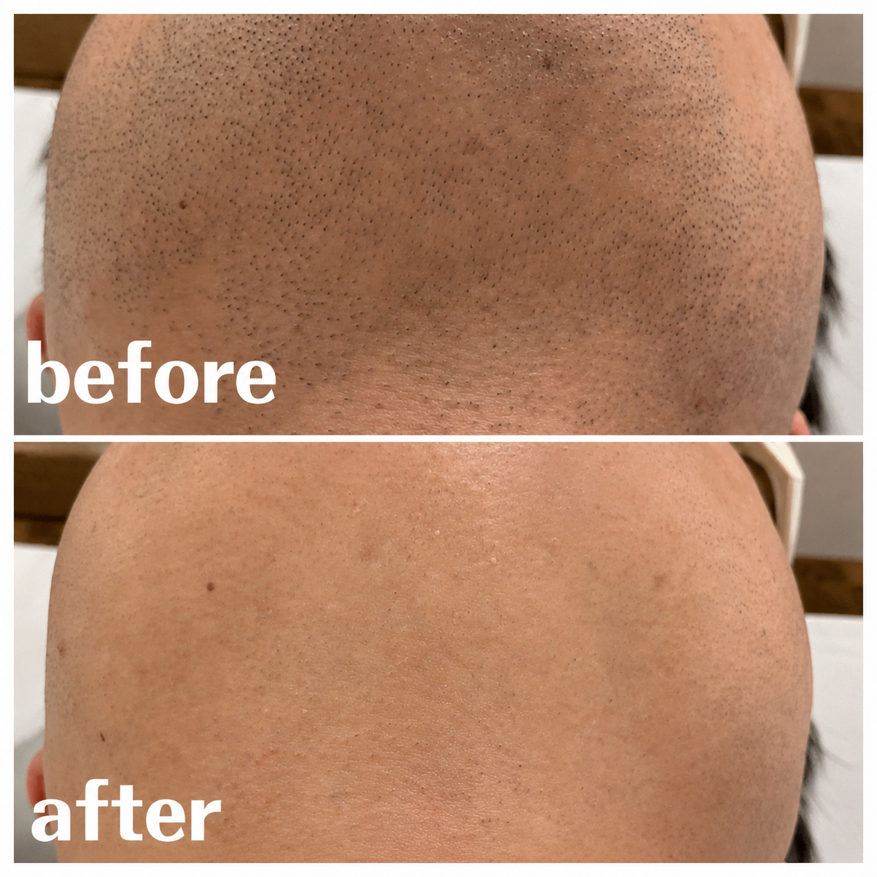 ヒゲ脱毛　BeforeAfter