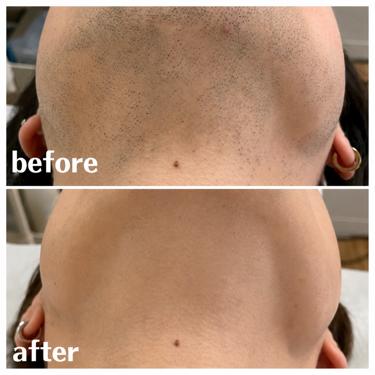 ヒゲ脱毛　BeforeAfter