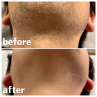 ヒゲ脱毛は痛い？奈良のメンズ脱毛サロンが正直に解説